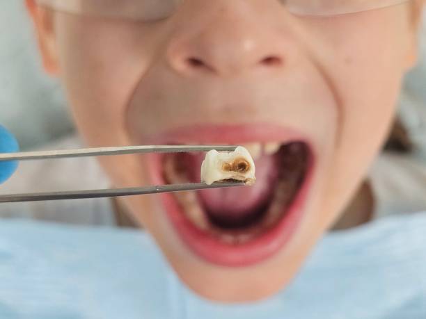 Best Emergency Dentist for Lost Fillings or Crowns in Logan, WV
